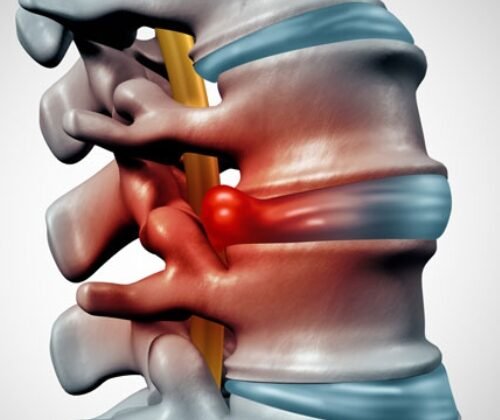 Understanding Trigeminal Neuralgia: Effective Treatment Options